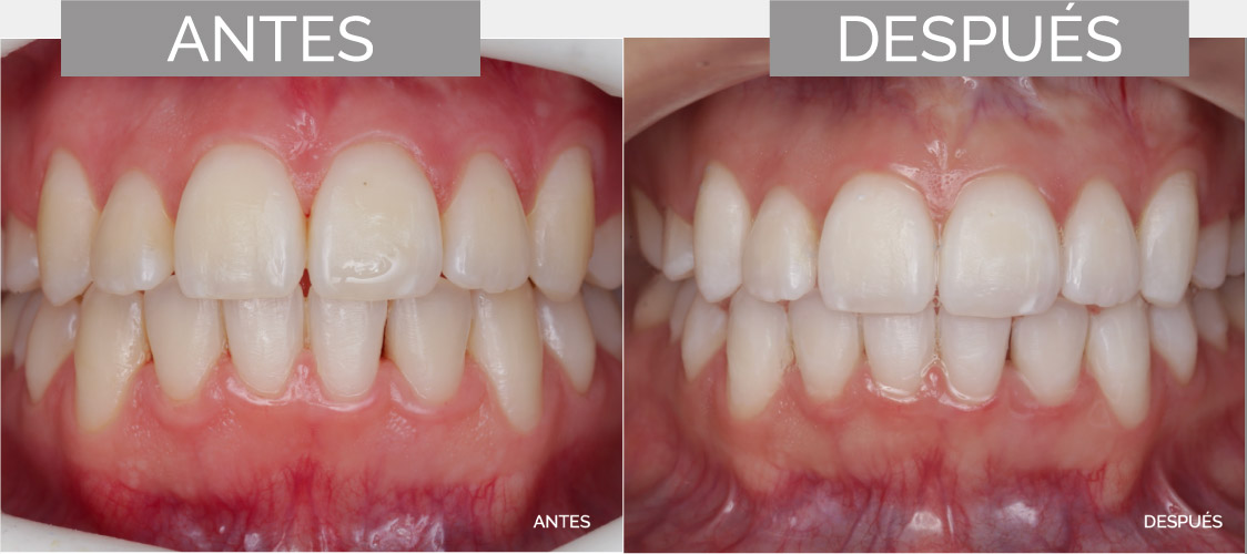 Diseño de sonrisa y estética dental en Cuenca